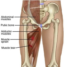 A medical illustration indicating a groin muscle injury