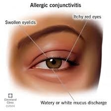 A close-up showing swollen, puffy eyes associated with allergies.