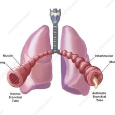 An anatomical illustration of human lungs and branching bronchial tubes.