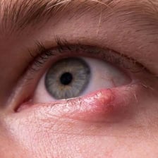 Close-up view of a stye on the edge of an eyelid