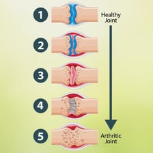 An educational illustration representing a sudden recurrence of pain or inflammation.