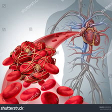 Medical illustration of a blood clot