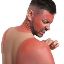 A close-up of skin reddened by sunburn.