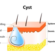 A simple medical illustration showing a cyst beneath the skin.