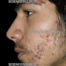 Visible acne blemishes on a person’s cheek