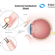 Medical illustration showing a stye on the eyelid