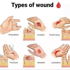 A medical illustration of a deep skin laceration