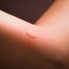 A small itchy insect bite visible on skin.