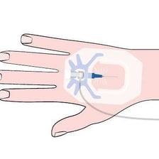 An intravenous fluid bag and tubing in a medical setting.