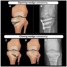 A medical illustration showing a bone cut and repositioned during an osteotomy.