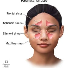 An anatomical illustration showing the air-filled sinus cavities in the human skull.