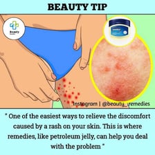 An educational illustration showing skin irritation caused by chafing