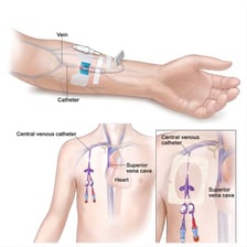 Medical illustration showing a catheter positioned inside a vein.