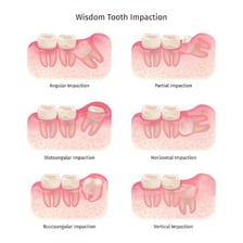 A dental illustration showing a wisdom tooth blocked beneath the gum
