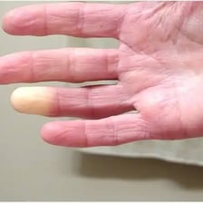 A person holding a numb hand after exposure to cold.