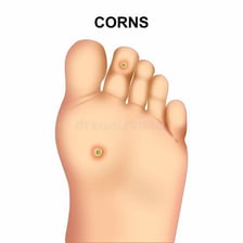 A medical illustration showing hardened corns on a foot.