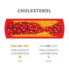 A medical illustration showing LDL cholesterol contributing to plaque in an artery.