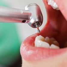 Dentist treating a tooth with dental instruments.