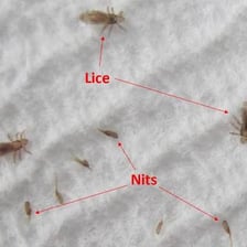 A close-up view of a nit attached to a hair shaft