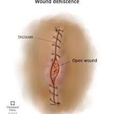 A medical illustration representing a deep cut.