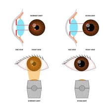 Medical illustration comparing a normal pupil with a widened, dilated pupil