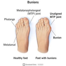 A foot showing a bunion at the base of the big toe