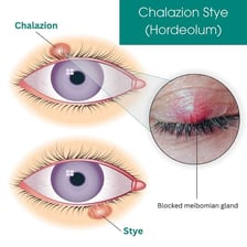 A medical illustration showing a stye on the eyelid