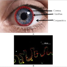 A medical illustration showing the cornea at the front of the human eye