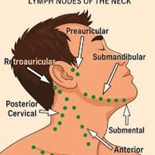 A medical illustration showing a swollen lymph node in the neck