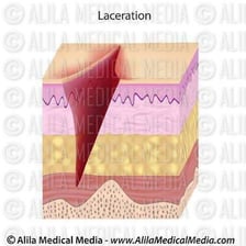 A medical illustration showing a laceration or cut