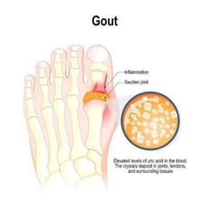 A swollen toe joint affected by gout
