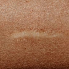 A healed scar visible on skin.