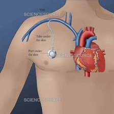 An educational illustration of a small implant being inserted near a vein