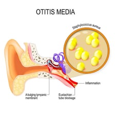 An educational illustration showing inflammation in the ear.
