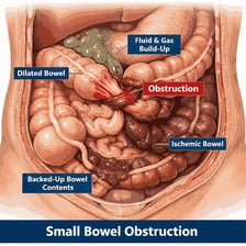 A medical illustration showing a section of intestine blocked by an occlusion.