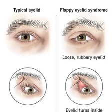 A tired person with eyelids drooping as they are about to fall asleep.