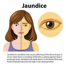 An educational medical illustration showing yellowish jaundiced skin.