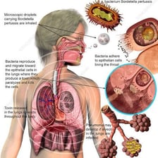 An educational illustration depicting a person coughing.