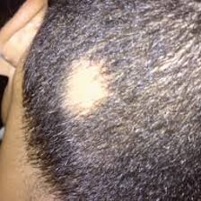 A close-up showing a bald patch on a scalp.