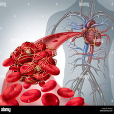 A medical illustration showing a blood clot inside a blood vessel