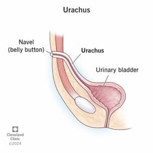 An anatomical illustration showing a protruding outie belly button.