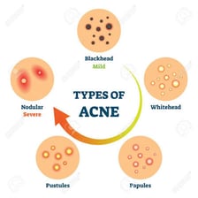 An educational close-up illustration showing acne blemishes on facial skin.