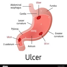 An educational illustration showing an ulcer in the stomach lining