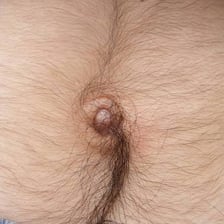 A close-up view of a protruding outie belly button