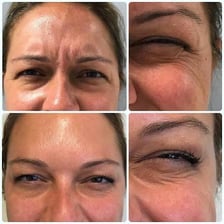 Illustration showing the vertical frown lines between the eyebrows commonly called “11 lines.”