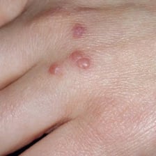 A small insect bite on skin being scratched because it is itchy.