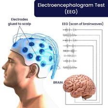 A patient receiving an EEG with electrodes attached to the scalp