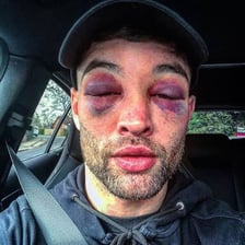 A boxer displaying a black eye after a fight.