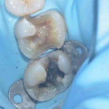 A visible crack in a wall and a cracked tooth