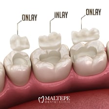 A dental inlay fitted into a prepared tooth cavity.
